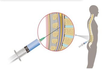 LUMBAR PUNCTURE