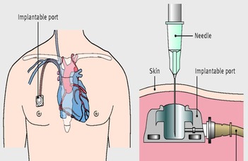 CENTRAL VENOUS CATHETERIZATION